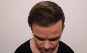 hajbeültetés árak